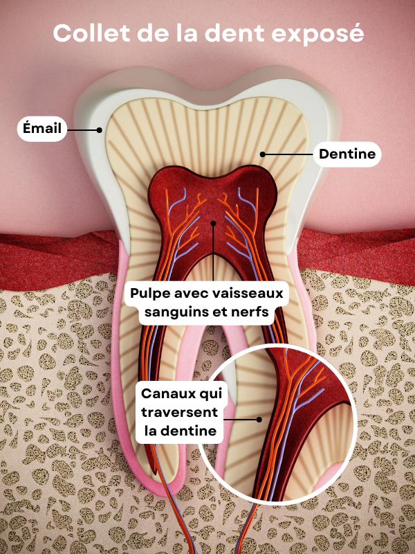 Schéma dents sensibles